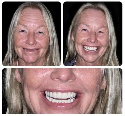 NESLEMY-🦷Advanced Customized Full Denture Set🦷 (⏰Limited time discount last 30 minutes⏰)