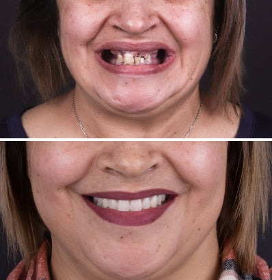 NESLEMY-🦷Advanced Customized Full Denture Set🦷 (⏰Limited time discount last 30 minutes⏰)